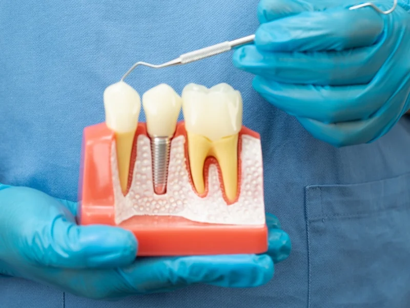 Dental Implant Illustration