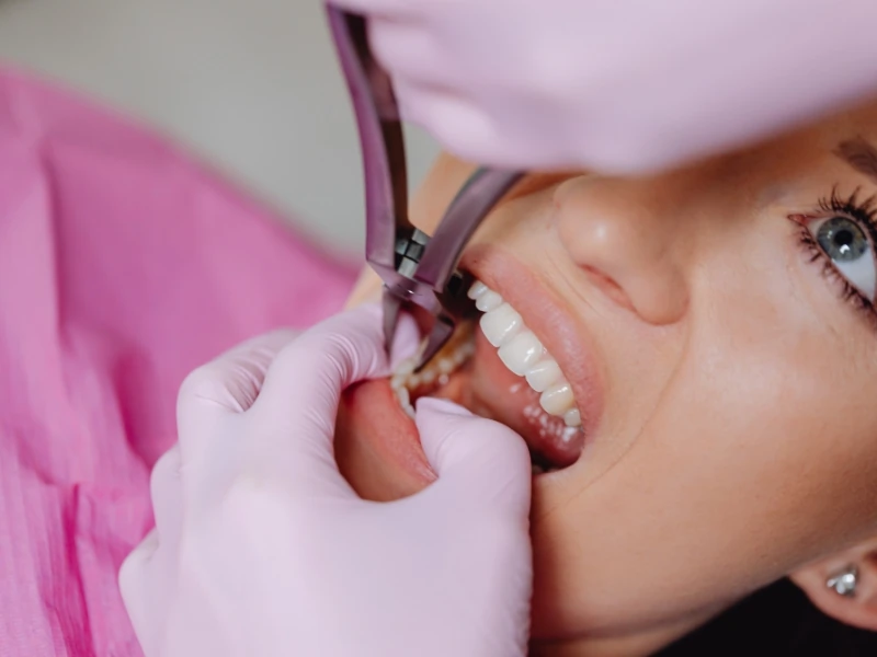 Tooth Extraction